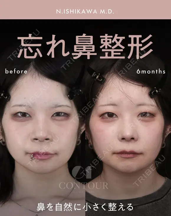 忘れ鼻整形 180日後 メイン用