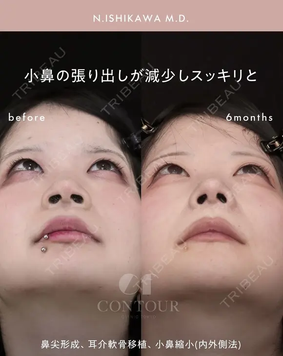 忘れ鼻整形 180日後 メイン用