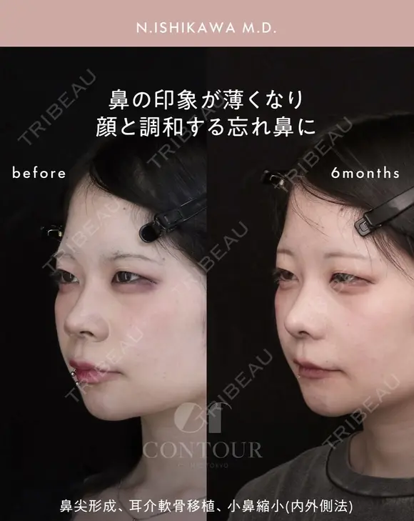 忘れ鼻整形 180日後 メイン用