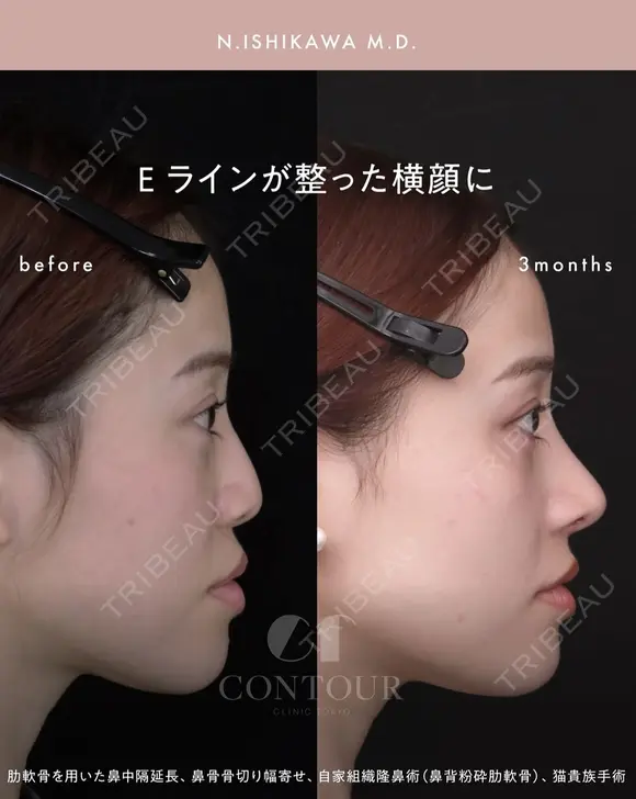 忘れ鼻整形 90日後 メイン用