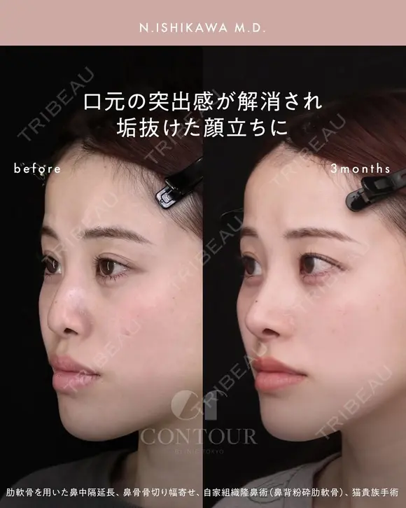 忘れ鼻整形 90日後 メイン用