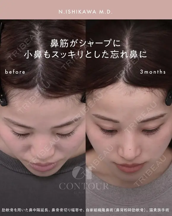 忘れ鼻整形 90日後 メイン用