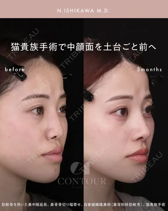 忘れ鼻整形 90日後 メイン用