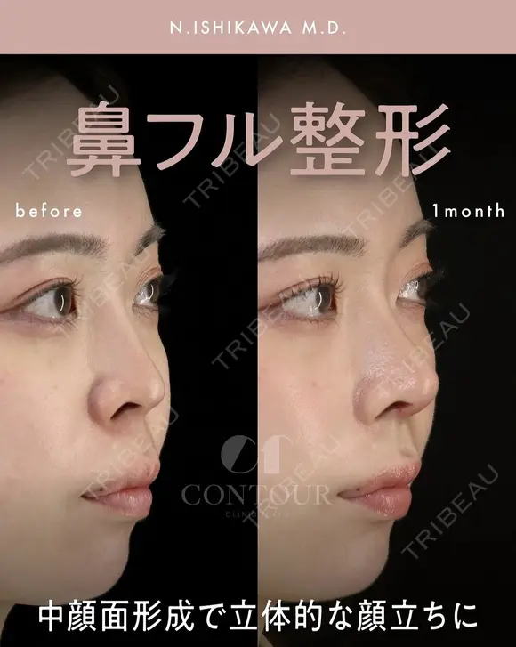忘れ鼻整形 30日後 メイン用