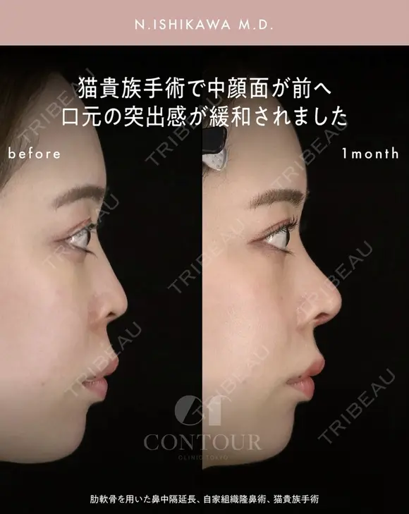 忘れ鼻整形 30日後 メイン用