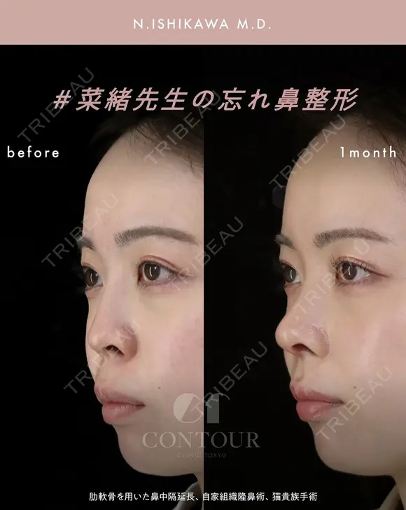 忘れ鼻整形 30日後 メイン用