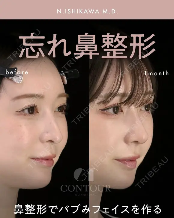 忘れ鼻整形 30日後 メイン用