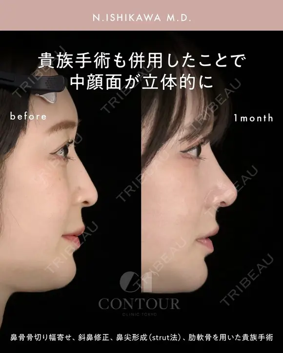 忘れ鼻整形 30日後 メイン用