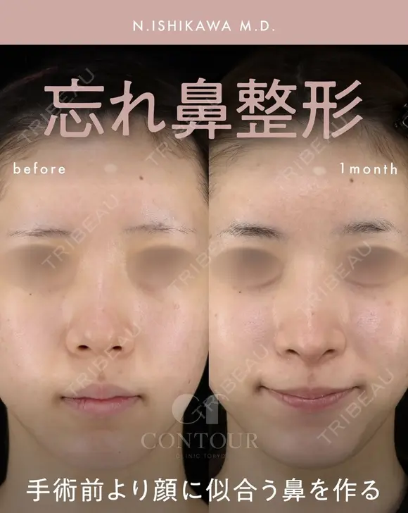 忘れ鼻整形 30日後 メイン用