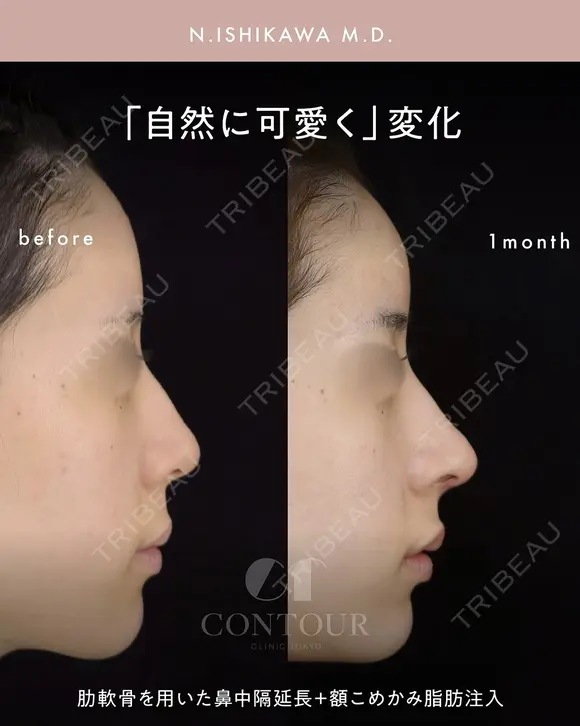 忘れ鼻整形 30日後 メイン用