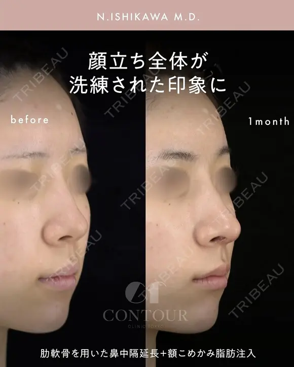忘れ鼻整形 30日後 メイン用