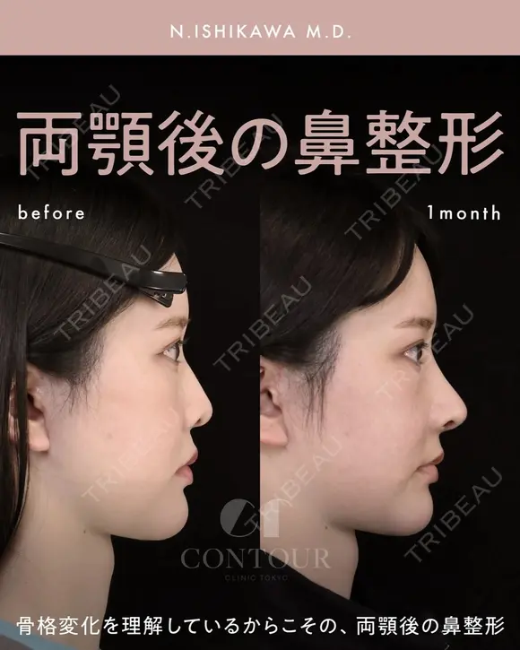 忘れ鼻整形 before画像 メイン用