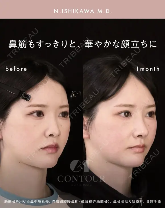 忘れ鼻整形 30日後 メイン用