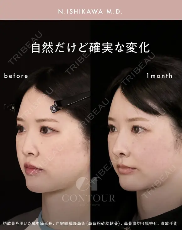 忘れ鼻整形 30日後 メイン用