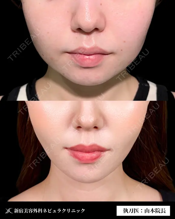 脂肪吸引で口横すっきり✨ before画像 メイン用