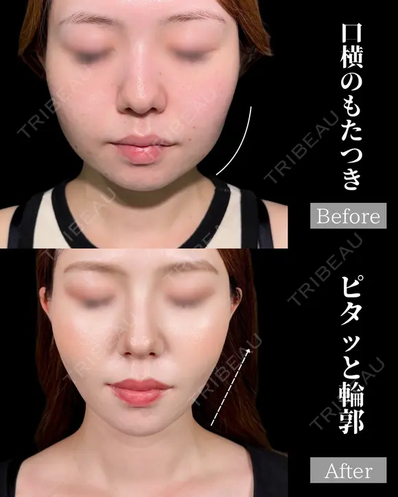脂肪吸引で口横すっきり✨ after画像 メイン用