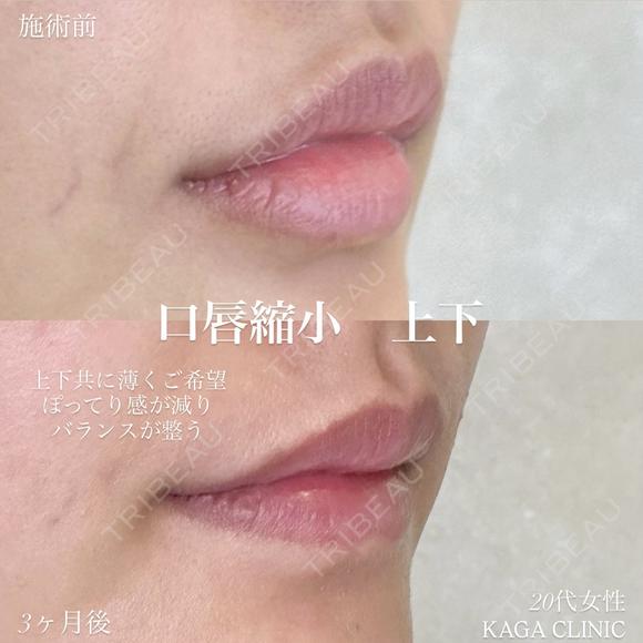 加賀デザイン×口唇縮小(上下) after画像 メイン用