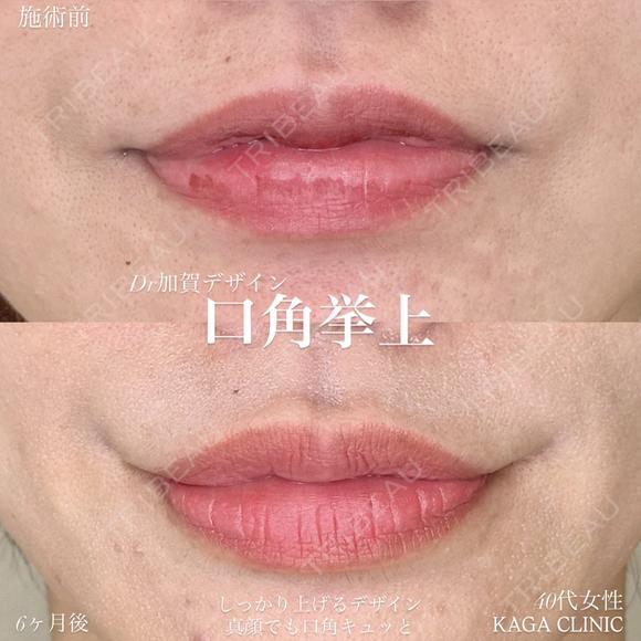 加賀デザイン×口角挙上 before画像 メイン用