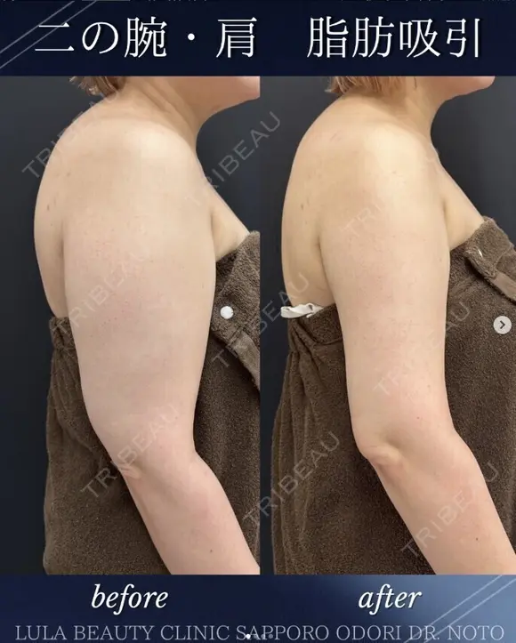 二の腕＋肩脂肪吸引 before画像 メイン用