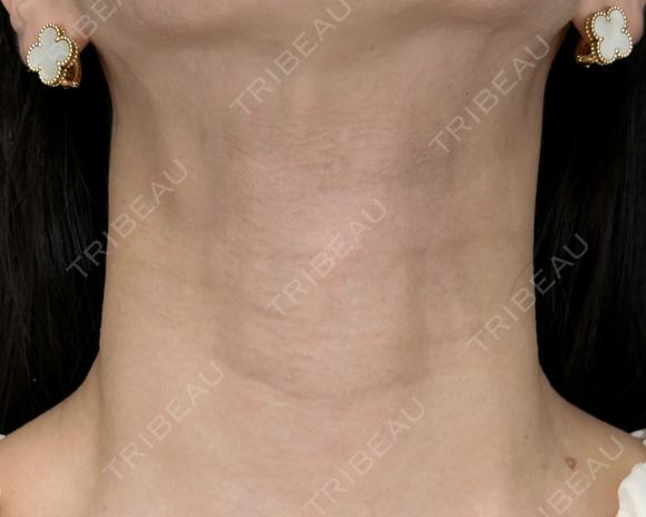 スキンバイブで首のシワ改善 before画像 メイン用