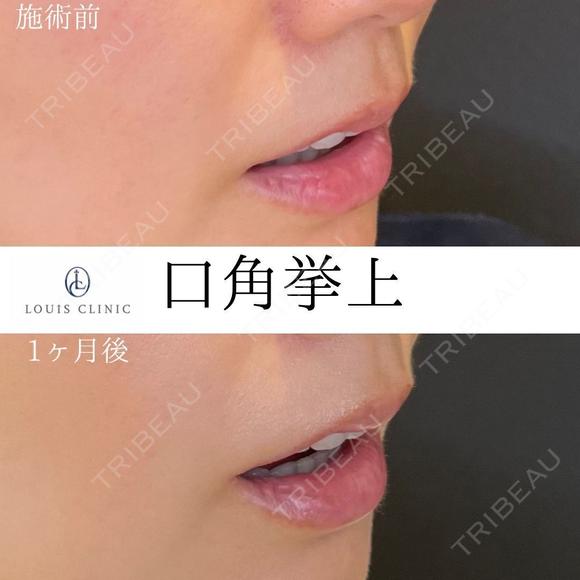 口角挙上 30日後 メイン用