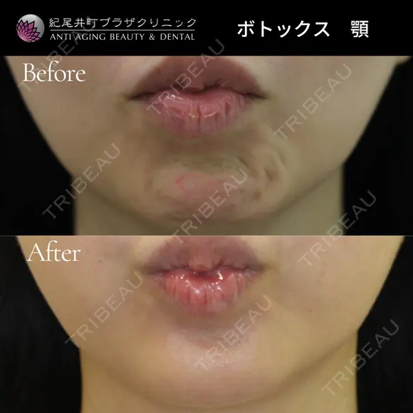 ボトックス注射（顎） before画像 メイン用