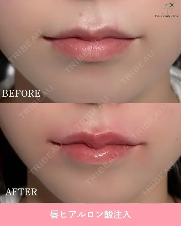 唇ヒアルロン酸 after画像 メイン用