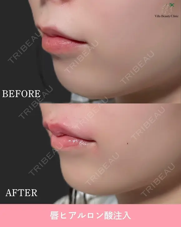 唇ヒアルロン酸 before画像 メイン用