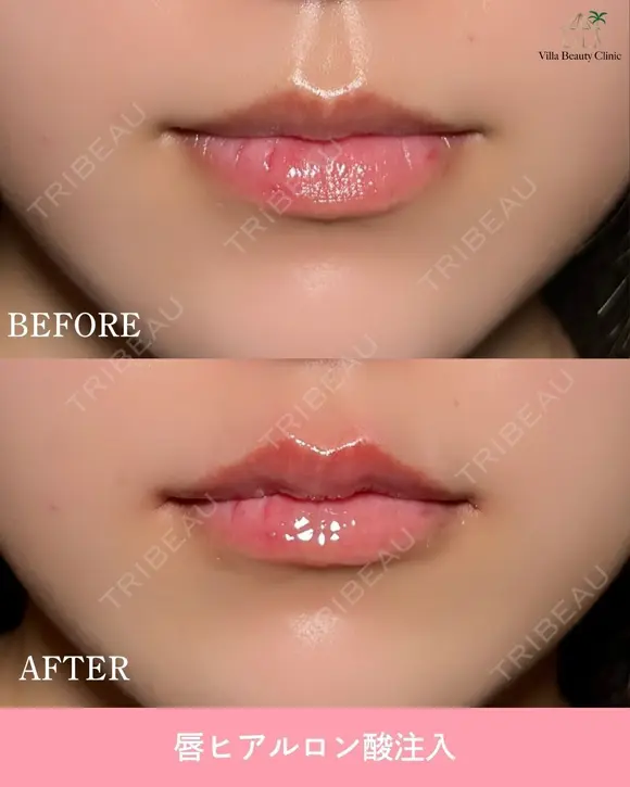 唇ヒアルロン酸 before画像 メイン用