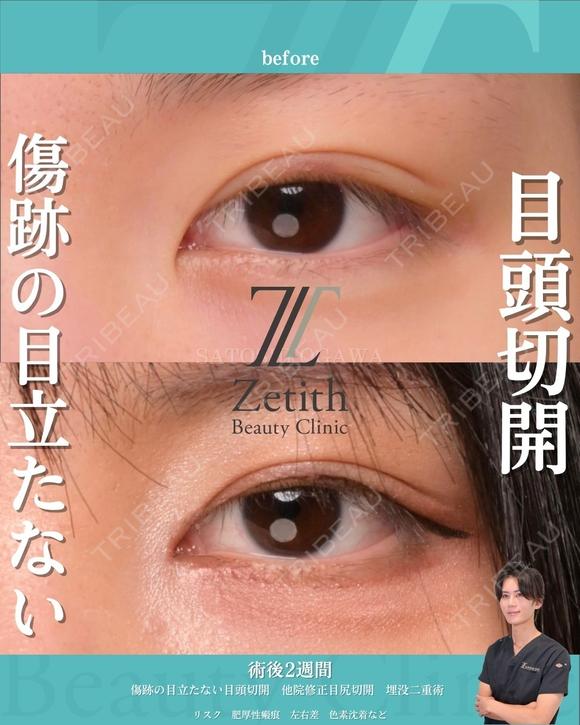 傷跡の目立たない目頭切開 before画像 メイン用