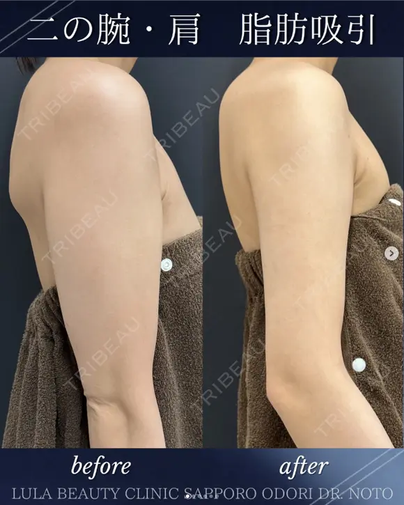 二の腕＋肩　脂肪吸引 before画像 メイン用