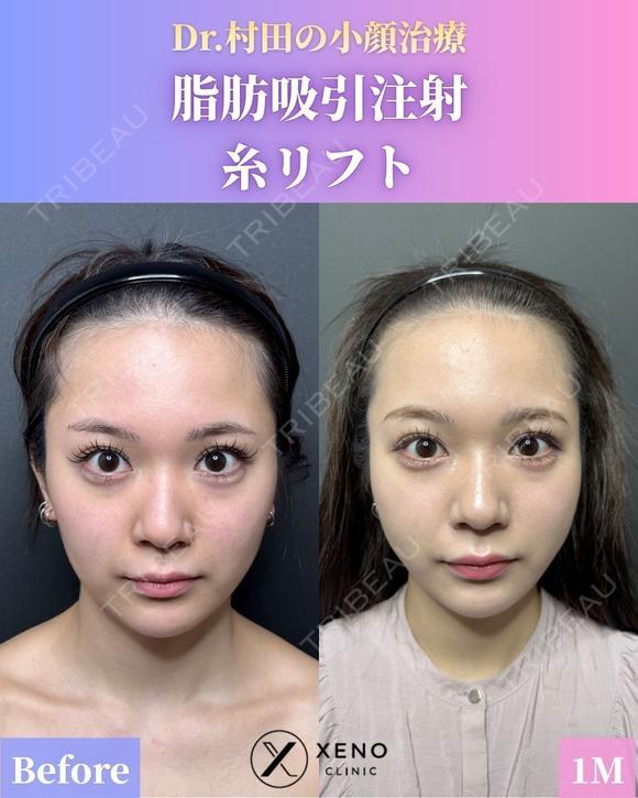 脂肪吸引注射（頬＋顎下＋ジョール）＋糸リフト＋頬・唇ヒアルロン酸 30日後 メイン用