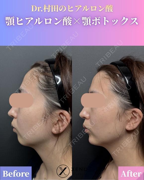 顎ヒアルロン酸＆顎ボトックス 0日後 メイン用