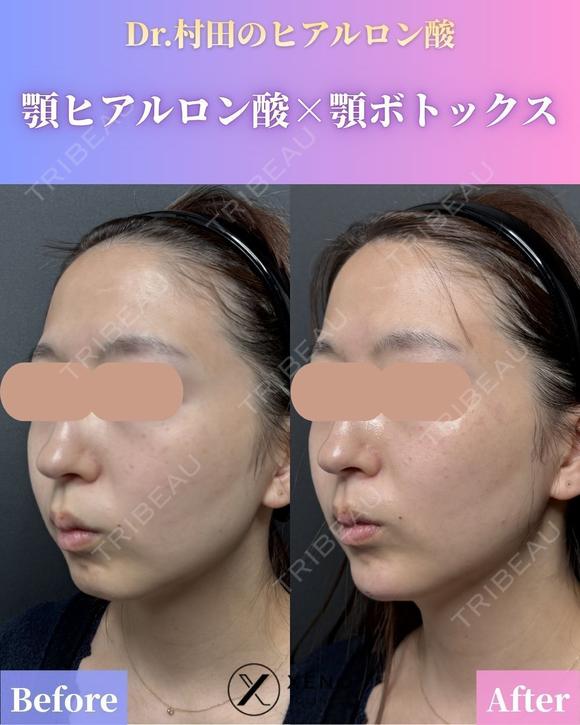 顎ヒアルロン酸＆顎ボトックス 0日後 メイン用