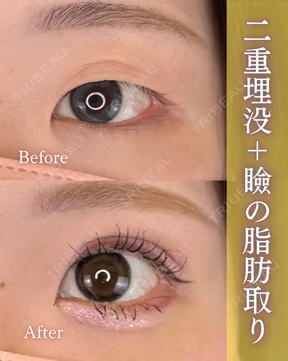 二重埋没+瞼の脂肪取り before画像 メイン用