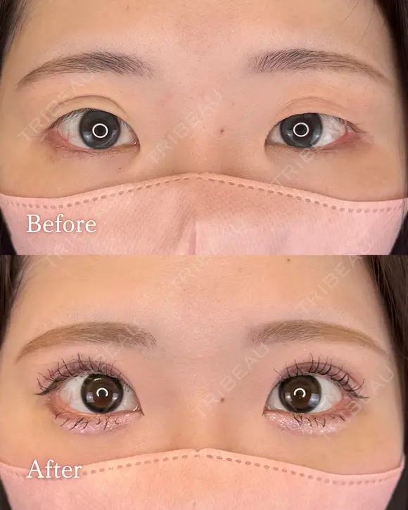二重埋没+瞼の脂肪取り after画像 メイン用