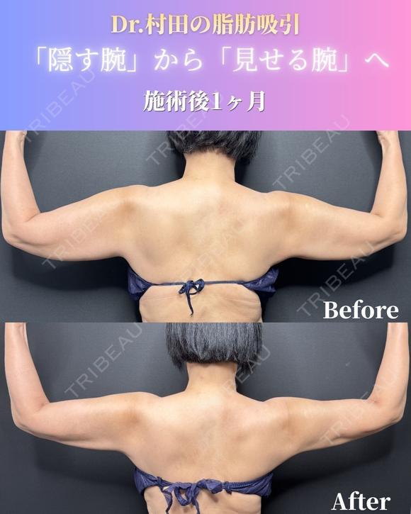 二の腕＋肩＋脇肉＋副乳　脂肪吸引 before画像 メイン用