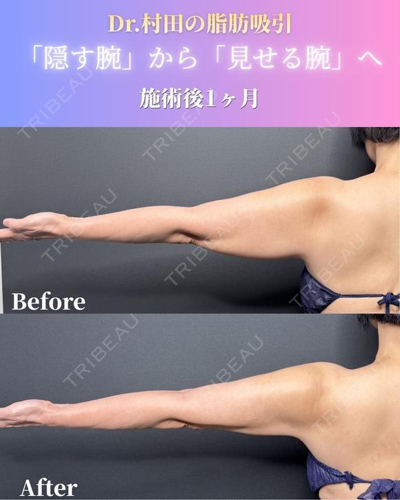 二の腕＋肩＋脇肉＋副乳　脂肪吸引 30日後 メイン用