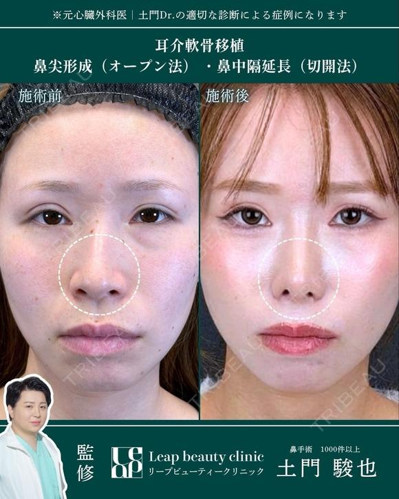 耳介軟骨移植・鼻尖形成・鼻中隔延長 before画像 メイン用