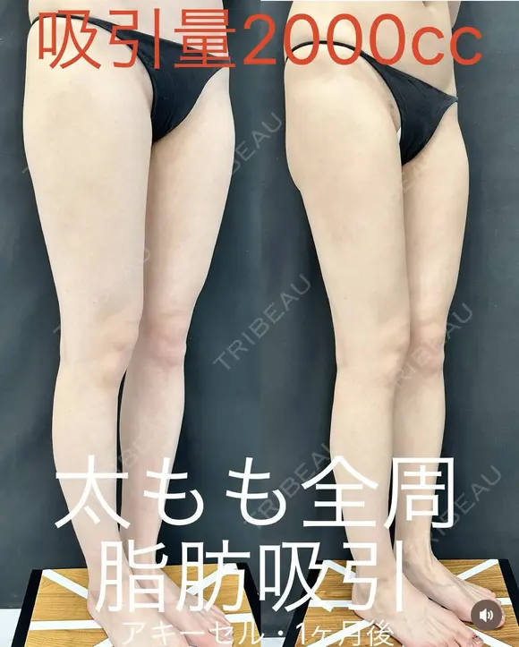 脂肪吸引　太もも全周 after画像 メイン用