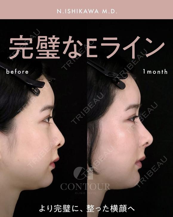 忘れ鼻整形 30日後 メイン用