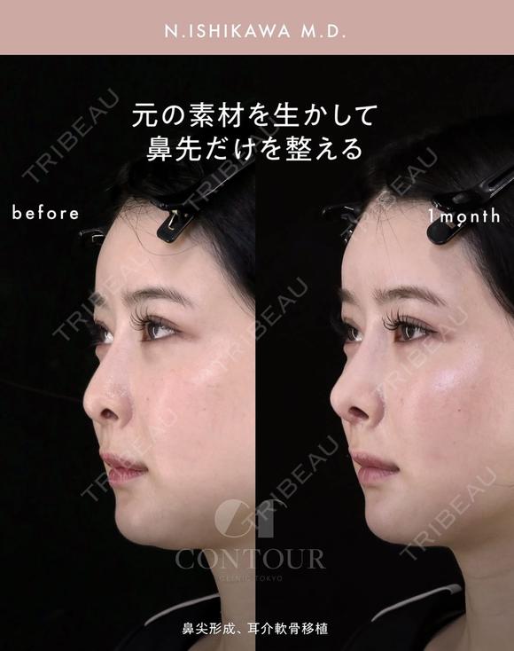 忘れ鼻整形 30日後 メイン用