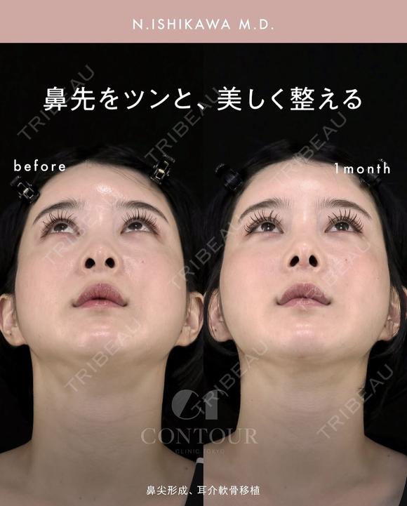 忘れ鼻整形 30日後 メイン用