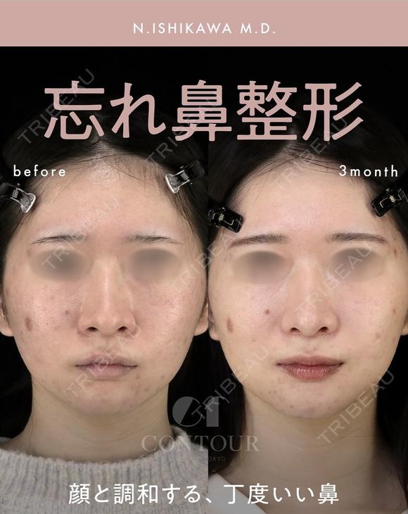 忘れ鼻整形 before画像 メイン用