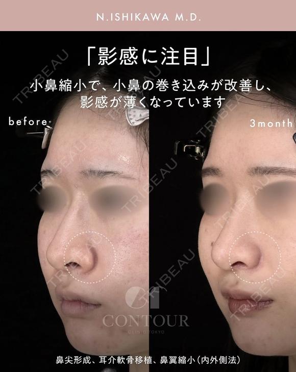 忘れ鼻整形 90日後 メイン用
