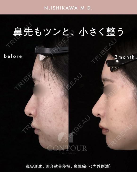 忘れ鼻整形 90日後 メイン用
