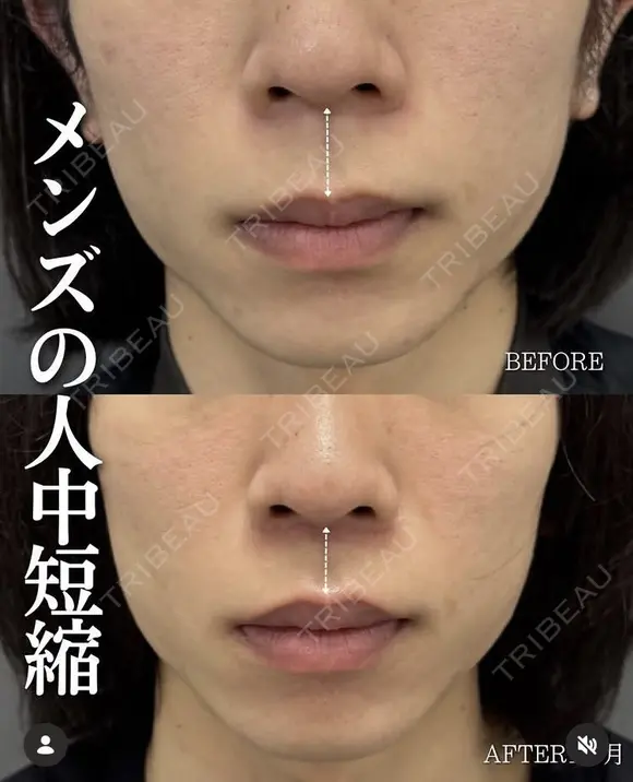 メンズ人中短縮術1ヶ月経過✨ after画像 メイン用