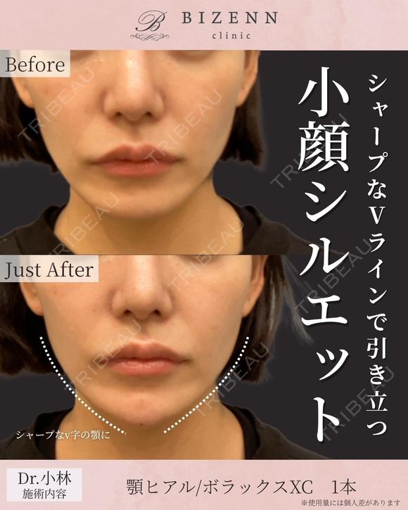 唇　😌ヒアルロン酸...	 after画像 メイン用