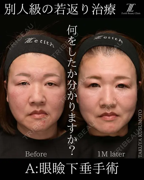 別人級の若返り治療 before画像 メイン用