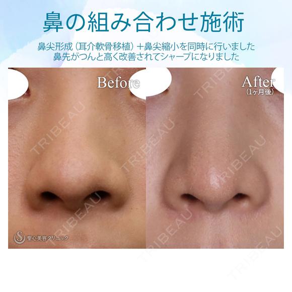 【20代女性・鼻先をスッキリ】鼻尖縮小＋耳介軟骨移植（1ヵ月後） before画像 メイン用